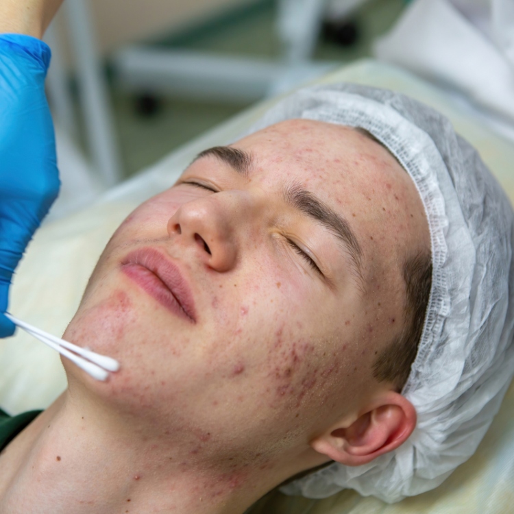 Acne Peel