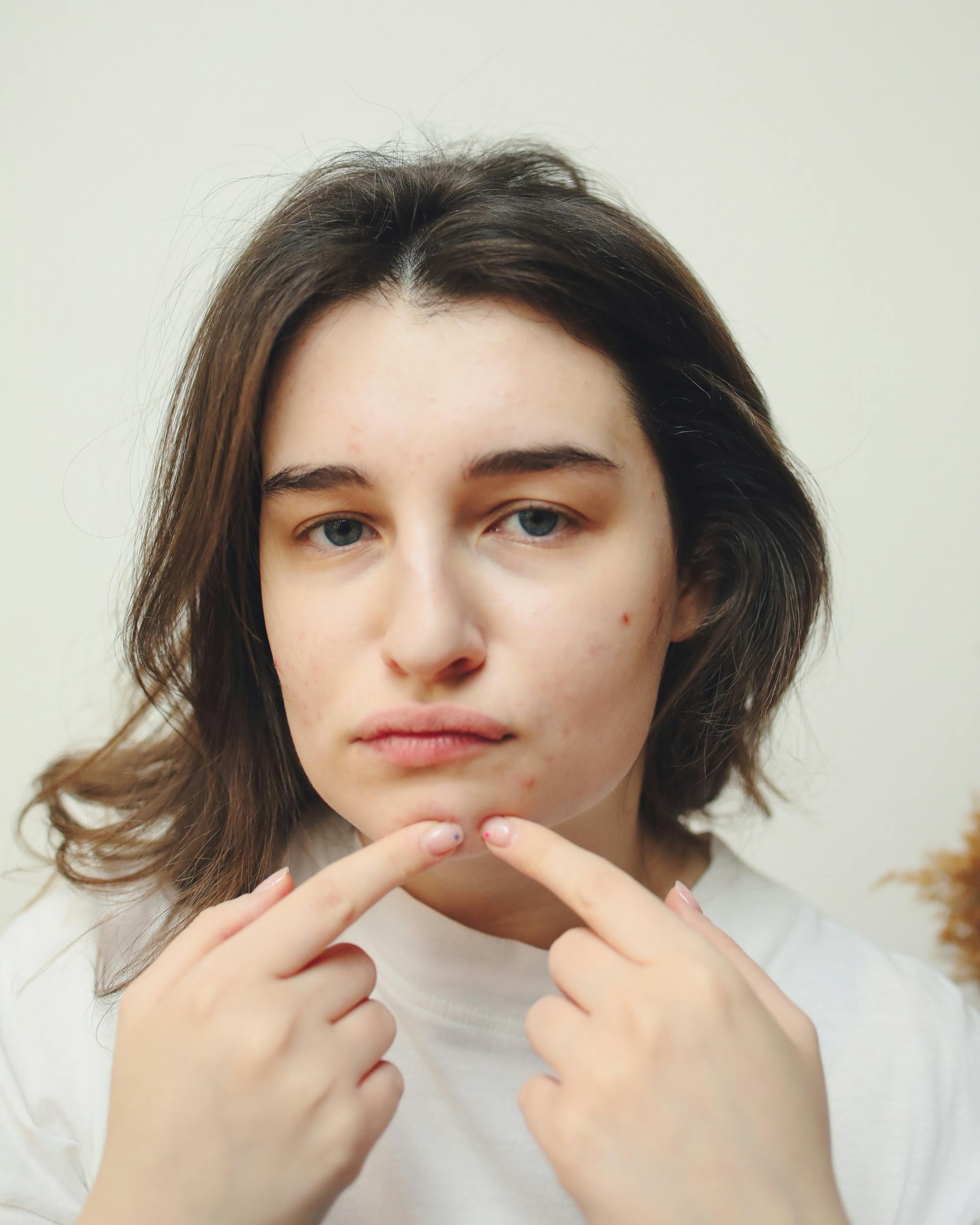 Why Acne Happens