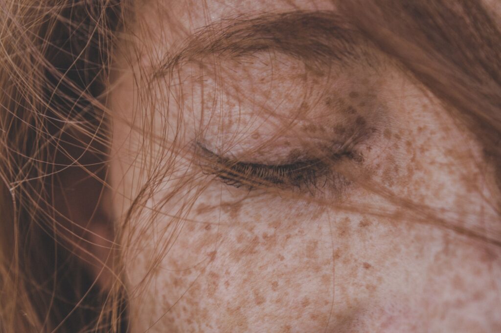 Hyperpigmentation BDSS